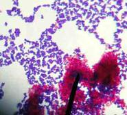 Acid Fast Stained Bacteria @1000xTM. Acid-fast Bacteria Stain Hot Pink. NonAcid-fast Stain Purple.