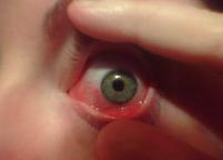 Allergic Conjunctivitis