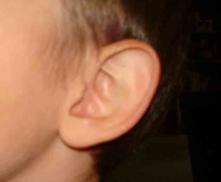 Free Earlobe, a Dominant Trait